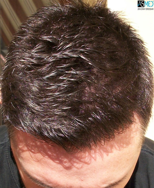Before and After  graft    transplant at 