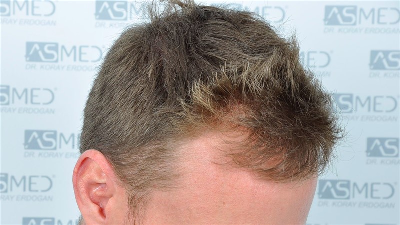 Before and After  graft    transplant at 