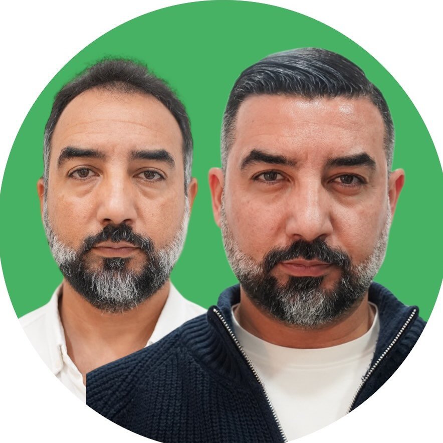 Adem Köse - Hair Transplant Turkey