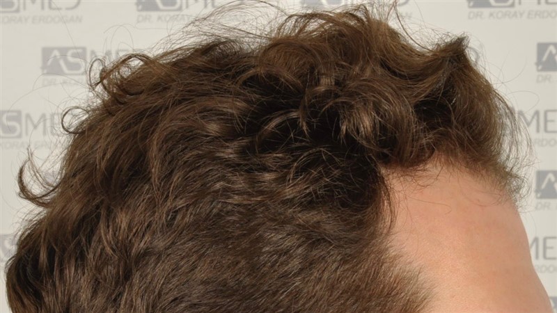 Before and After  graft    transplant at 