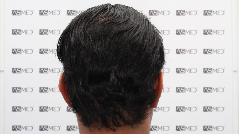 FUE Hair Transplant Result