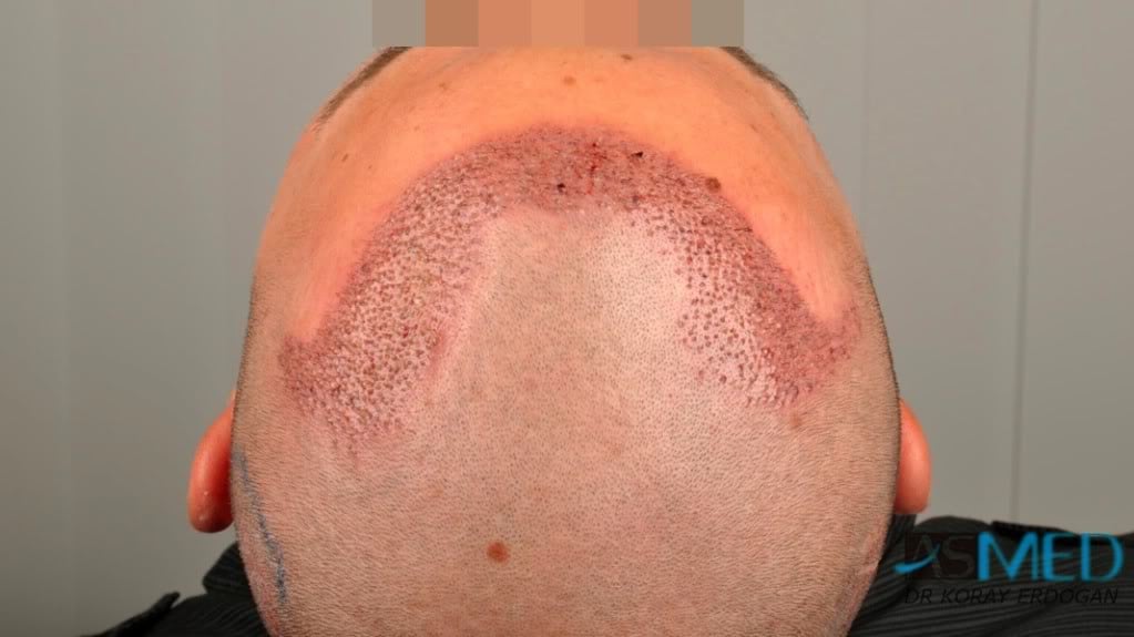Before and After  graft    transplant at 