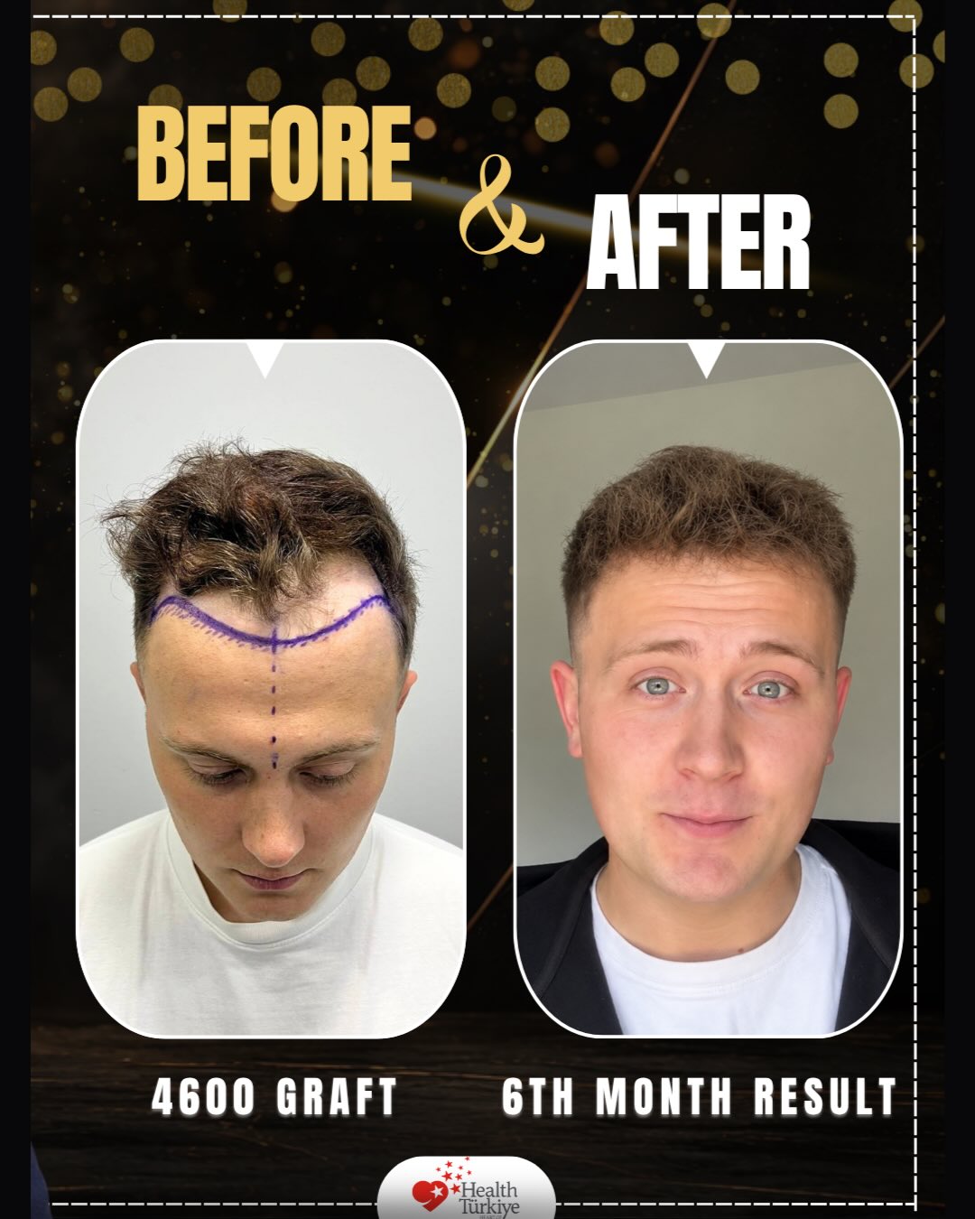 Before and After 4600 graft  DHI hair transplant at Elit İstanbul Hair Transplant