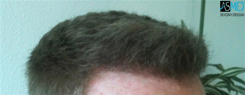 Before and After  graft    transplant at 