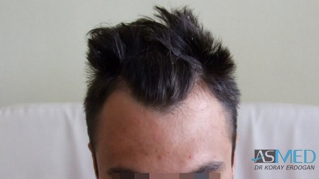 Before and After  graft    transplant at 