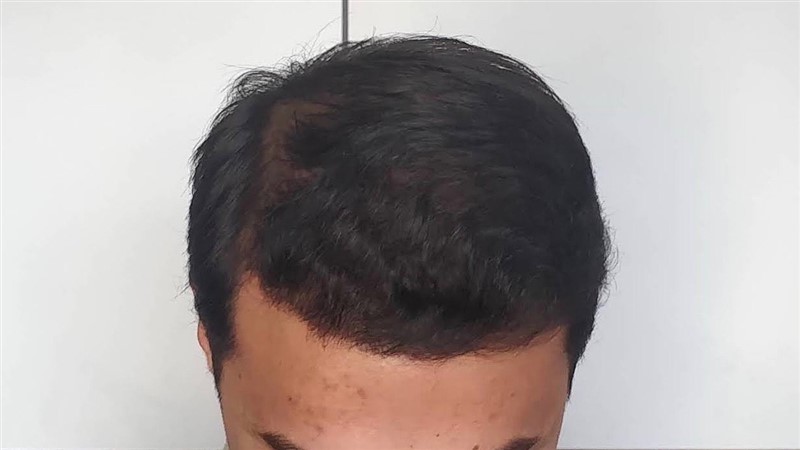 FUE Hair Transplant Result