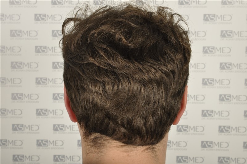 Before and After  graft    transplant at 