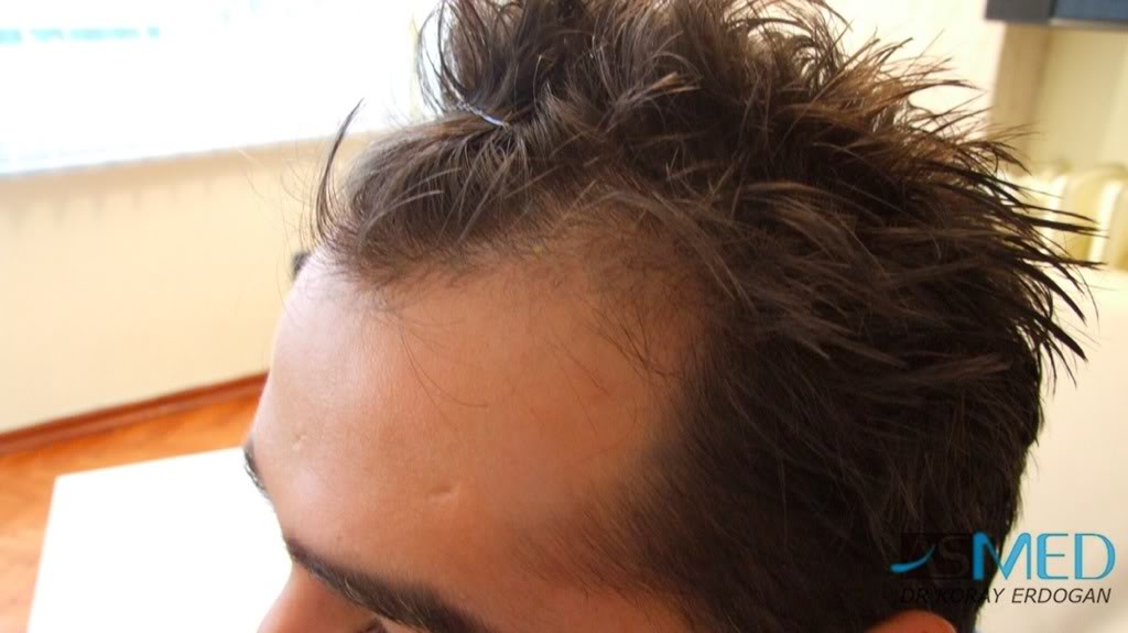 Before and After  graft    transplant at 