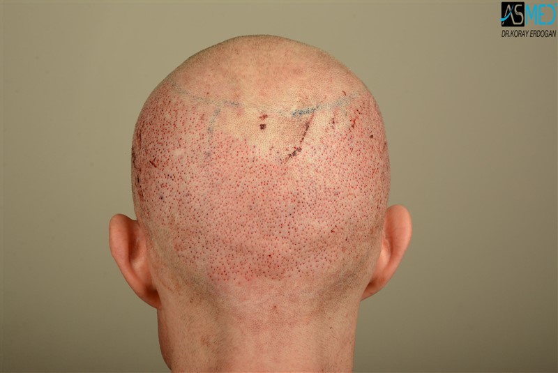 Before and After  graft    transplant at 