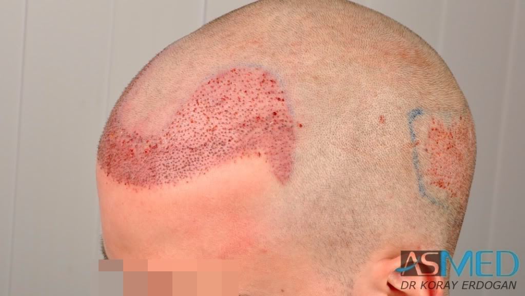 Before and After  graft    transplant at 