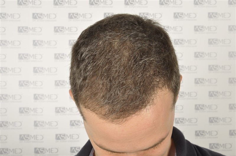 FUE Hair Transplant Result