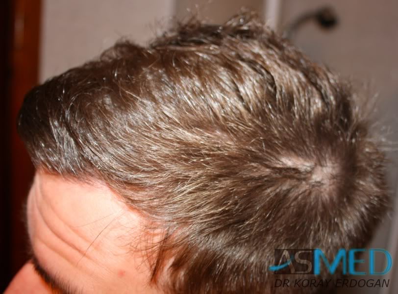 Before and After  graft    transplant at 