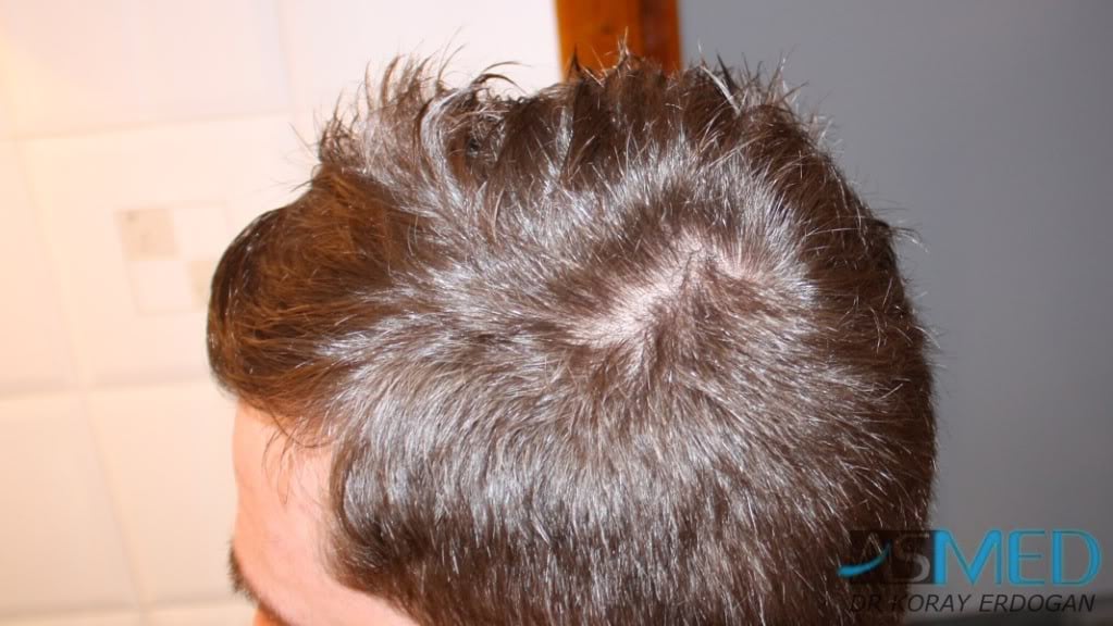 Before and After  graft    transplant at 