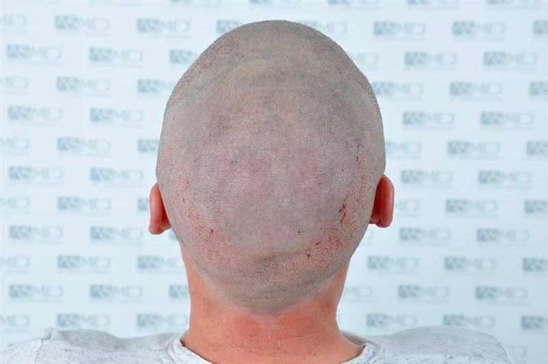 Before and After  graft    transplant at 