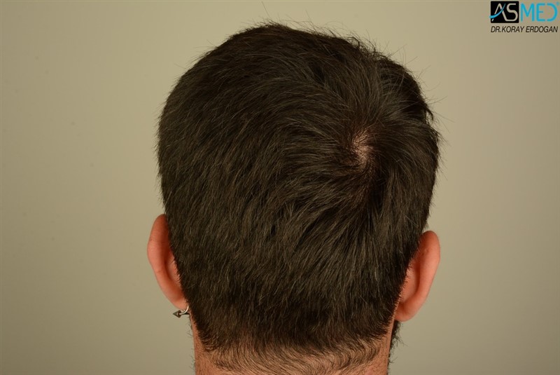 Before and After  graft    transplant at 