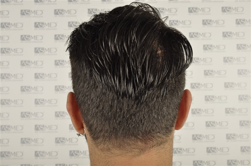 Before and After  graft    transplant at 