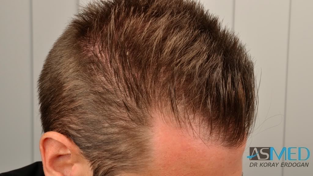 Before and After  graft    transplant at 