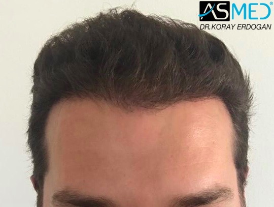 Before and After 2808 graft  FUE hair transplant at ASMED Medical Center