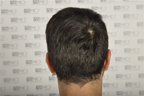 Before and After  graft    transplant at 