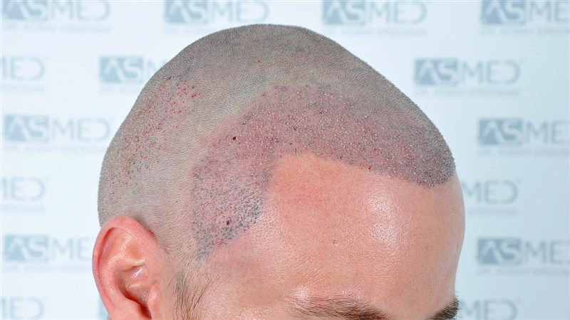 Before and After  graft    transplant at 