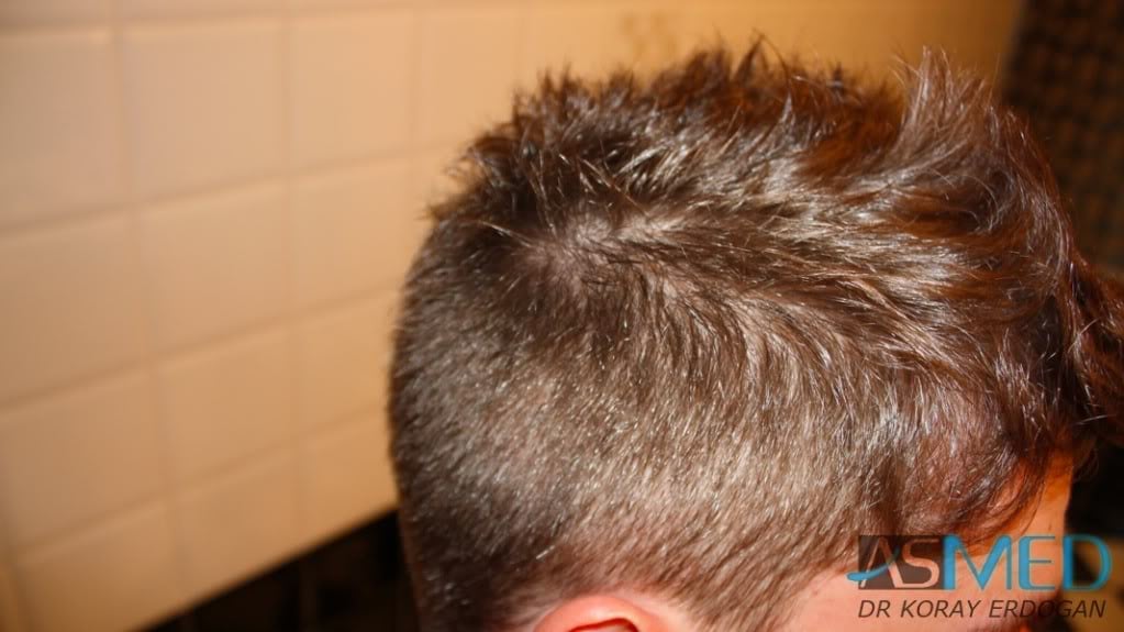 Before and After  graft    transplant at 
