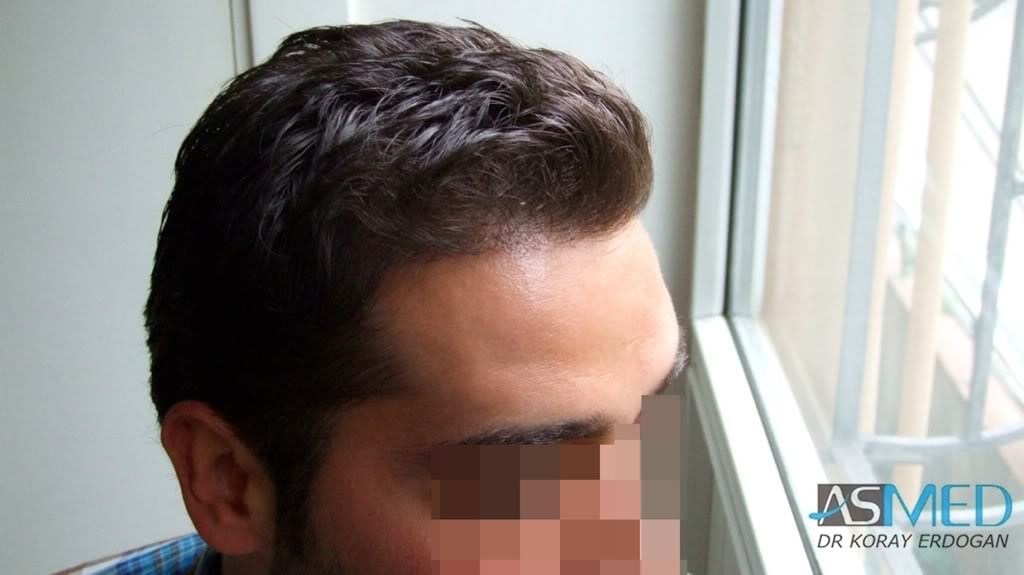 Before and After  graft    transplant at 
