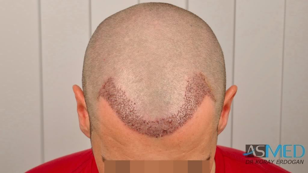 Before and After  graft    transplant at 