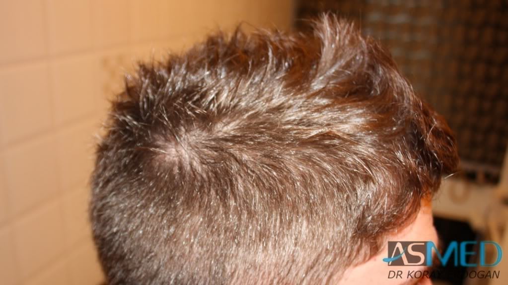 Before and After  graft    transplant at 