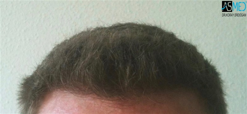 Before and After 3003 graft  FUE hair transplant at ASMED Medical Center