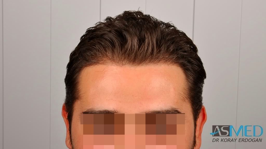Before and After 1650 graft  FUE hair transplant at ASMED Medical Center