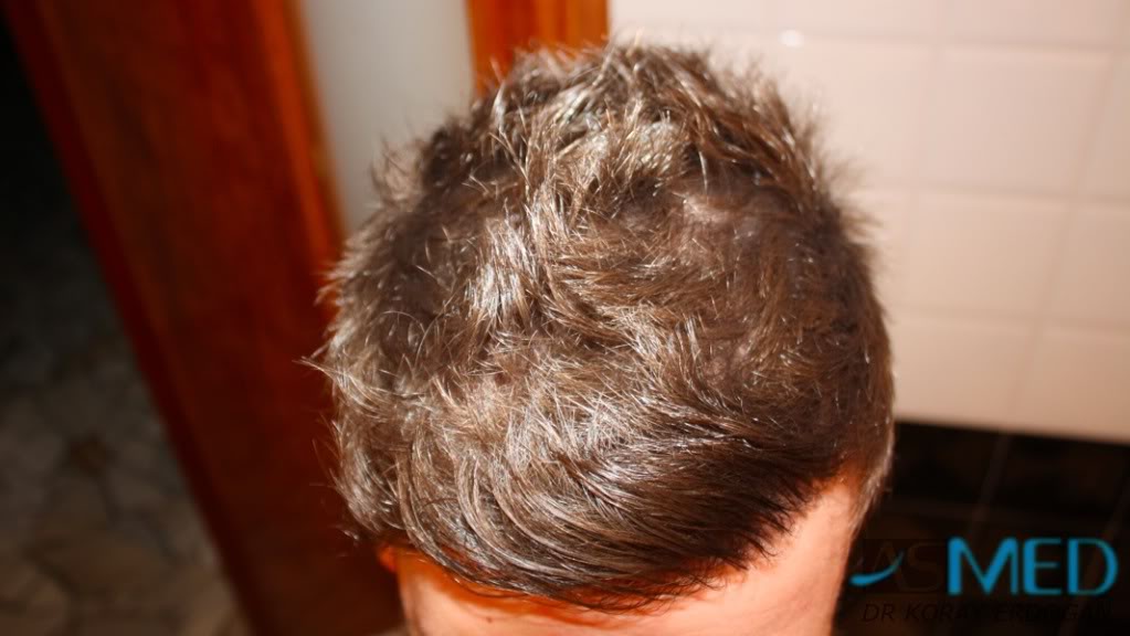 Before and After  graft    transplant at 