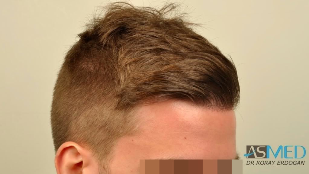 Before and After  graft    transplant at 