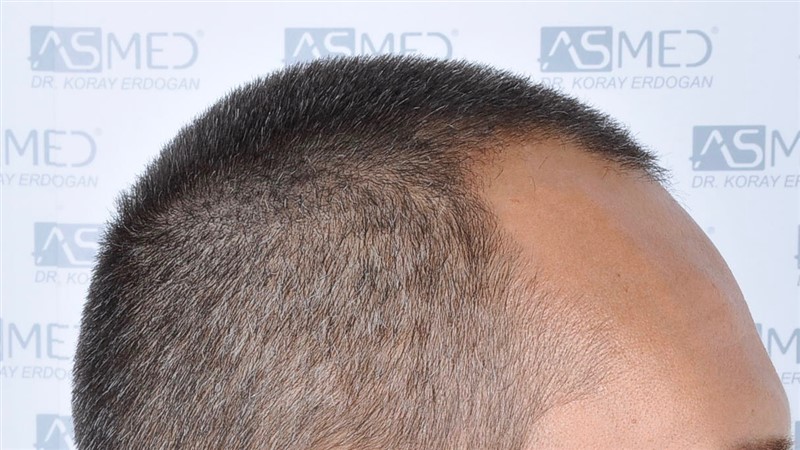Before and After  graft    transplant at 