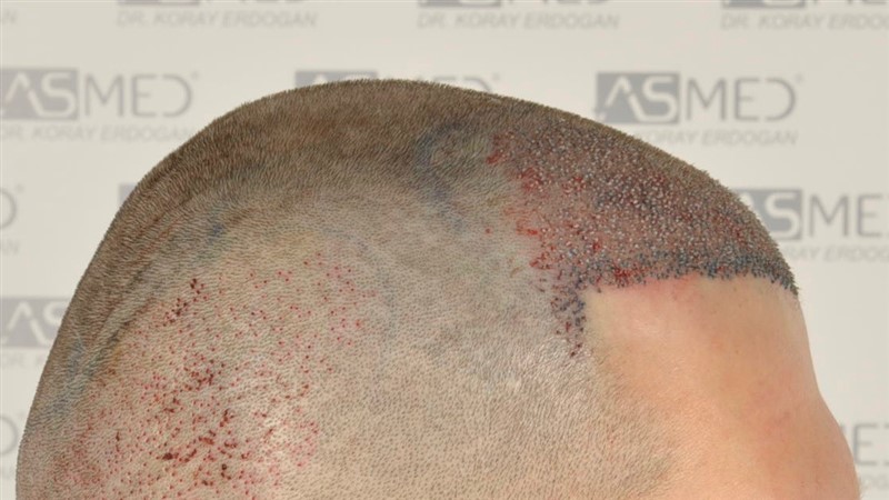 Before and After  graft    transplant at 