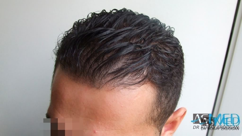 Before and After  graft    transplant at 