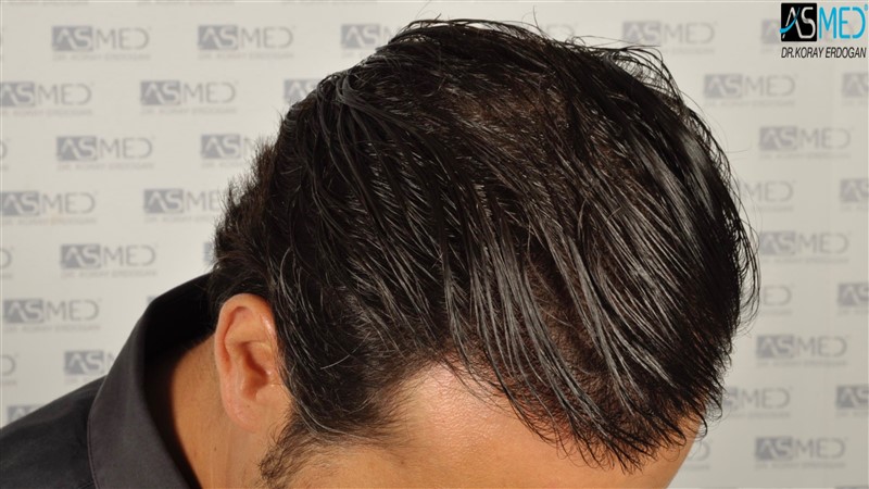 Before and After  graft    transplant at 