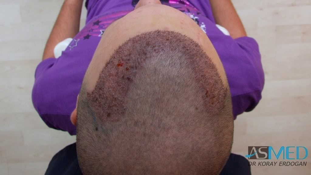 Before and After  graft    transplant at 