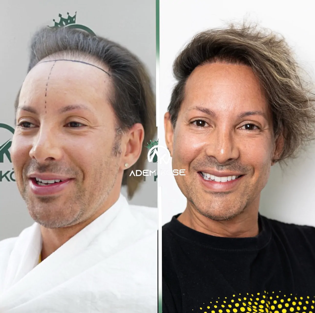 DHI Hair Transplant Result