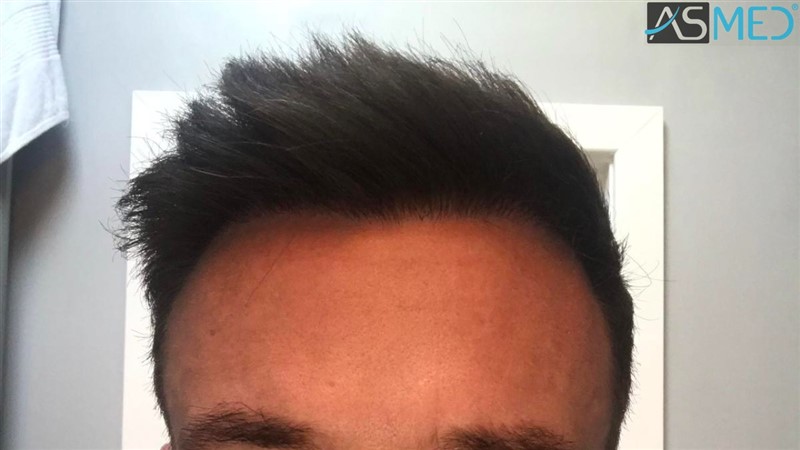 Before and After 3020 graft  FUE hair transplant at ASMED Medical Center