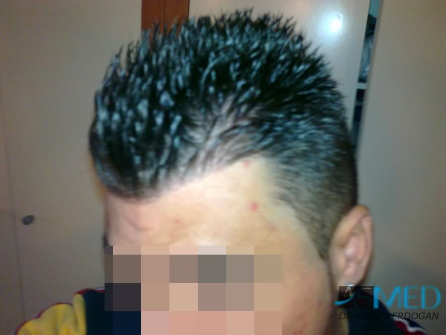 Before and After  graft    transplant at 