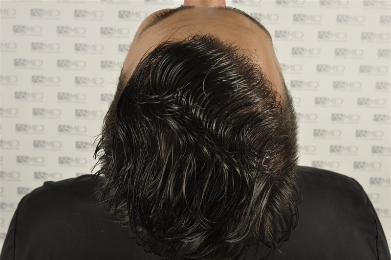Before and After  graft    transplant at 