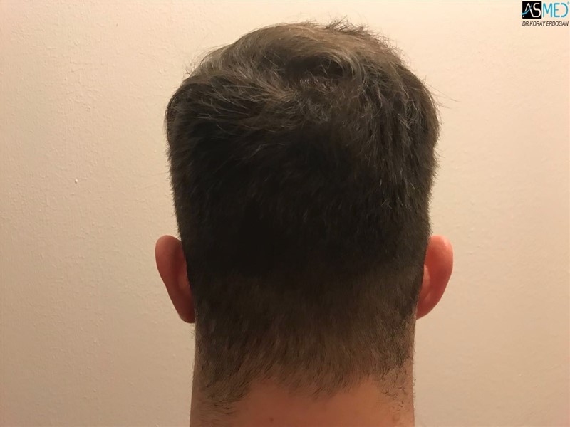 FUE Hair Transplant Result