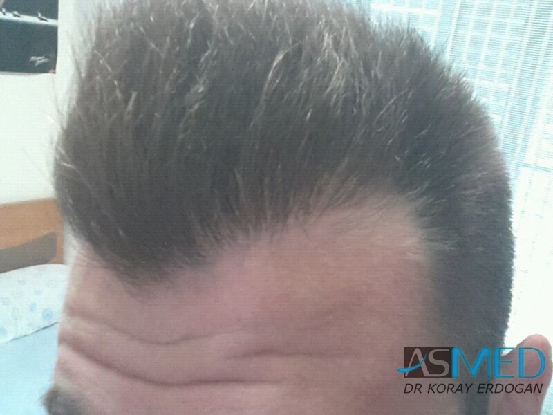 Before and After  graft    transplant at 