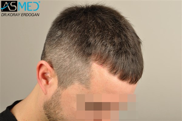 Before and After  graft    transplant at 