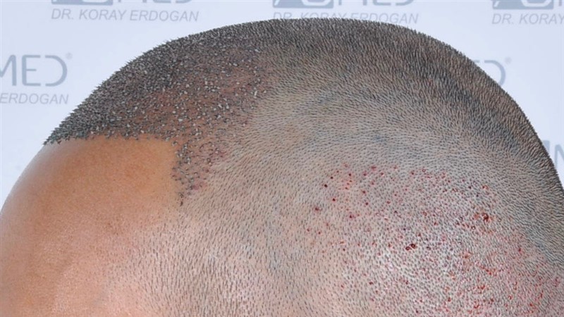 Before and After  graft    transplant at 