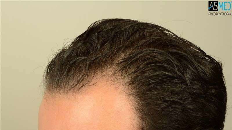 Before and After  graft    transplant at 