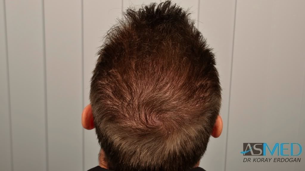Before and After  graft    transplant at 