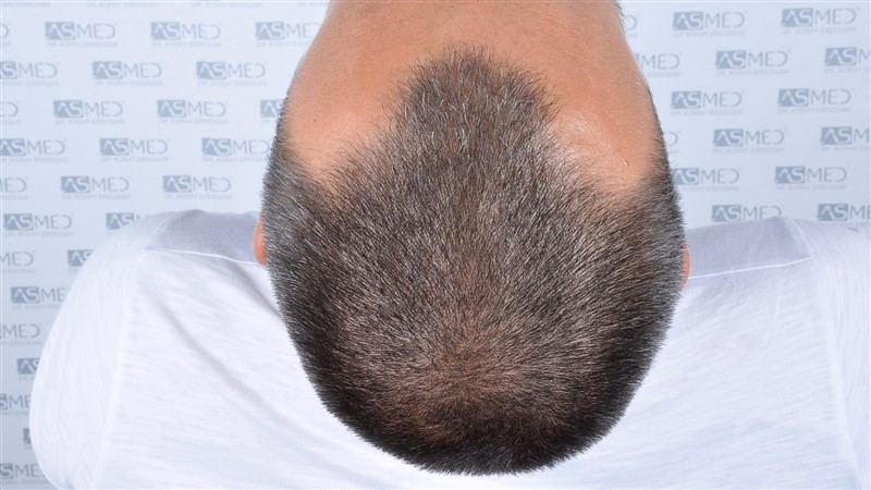 Before and After  graft    transplant at 