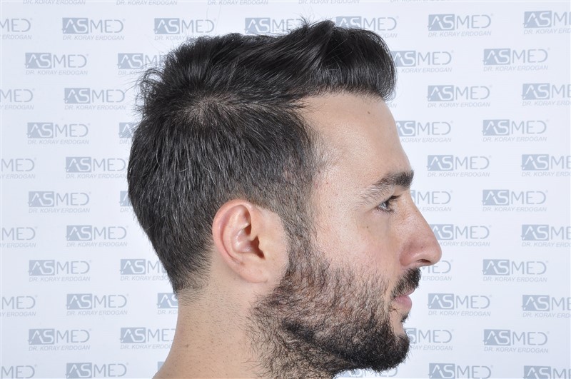 Before and After  graft    transplant at 