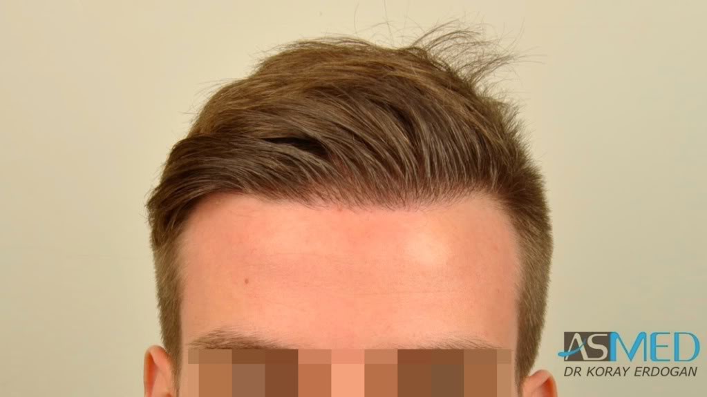 Before and After  graft    transplant at 